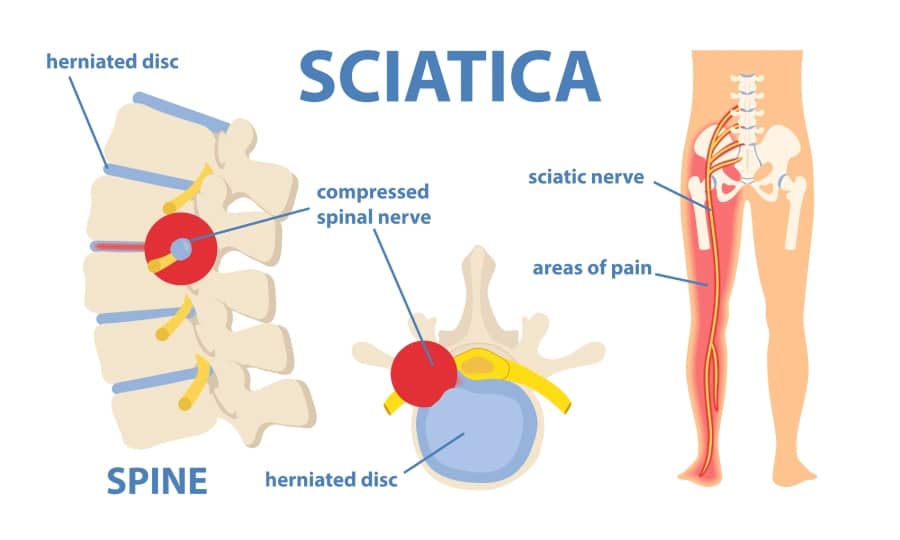 Diagram of the Scatic nerve showing where sciatica comes from
